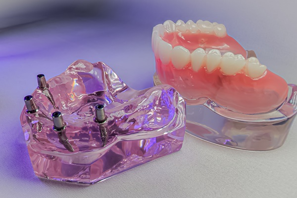 When To Consider Implant Supported Dentures Over Traditional Dentures